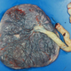 A placenta taken from a women who contracted covid-19. Researchers found that infected women had a greater risk of blood flow problems in their placenta, which could be harmful to their pregnancy.